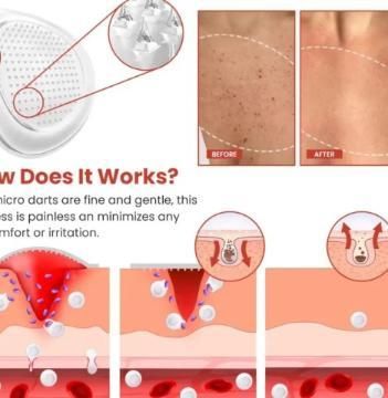 Cura Skin Tag Remover Patch โ Safe, Fast & Painless